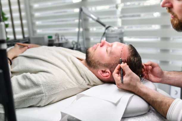 Hair Transplant Markings On Male's Forehead By Expert Beautician