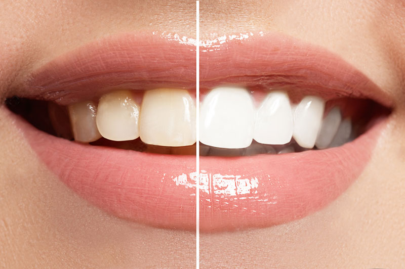Restoring Smiles